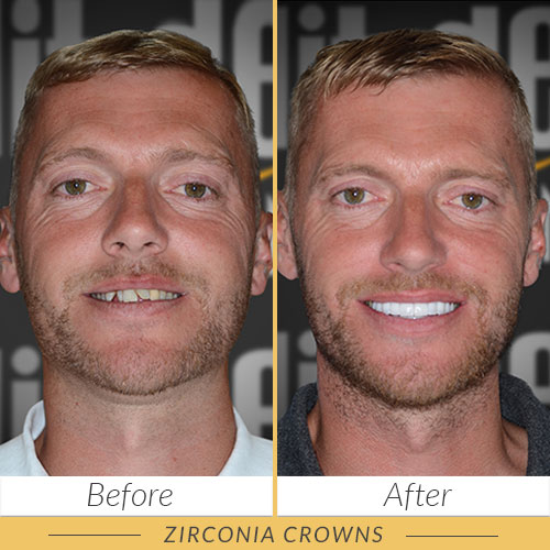 zirconia crowns kusadasi