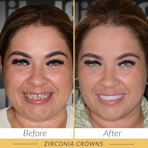 zirconia crowns kusadasi