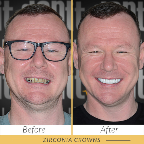 zirconia crowns kusadasi