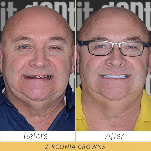 zirconia crowns kusadasi