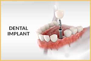 Straumann Dental Implants