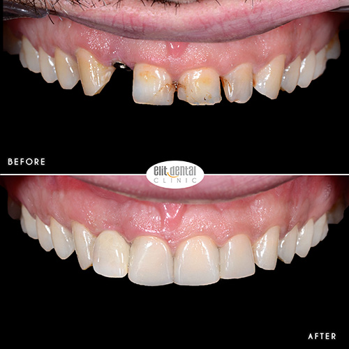 iveneers-composite-system