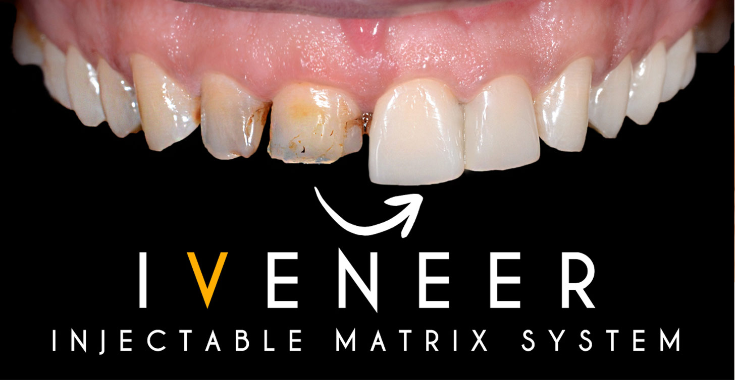 iveneers turkey kusadasi