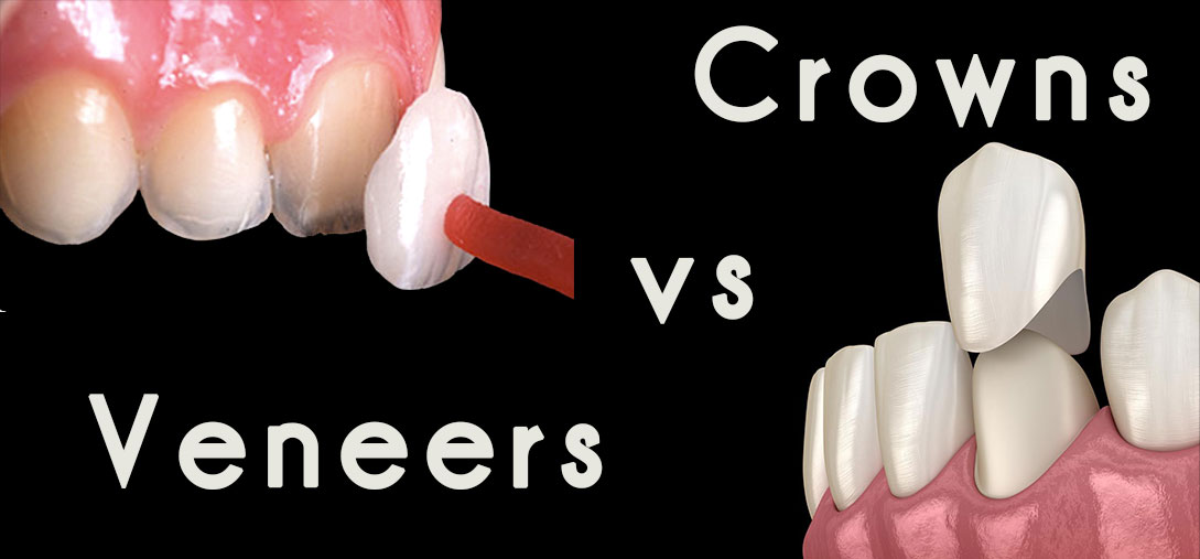 veneers vs crowns