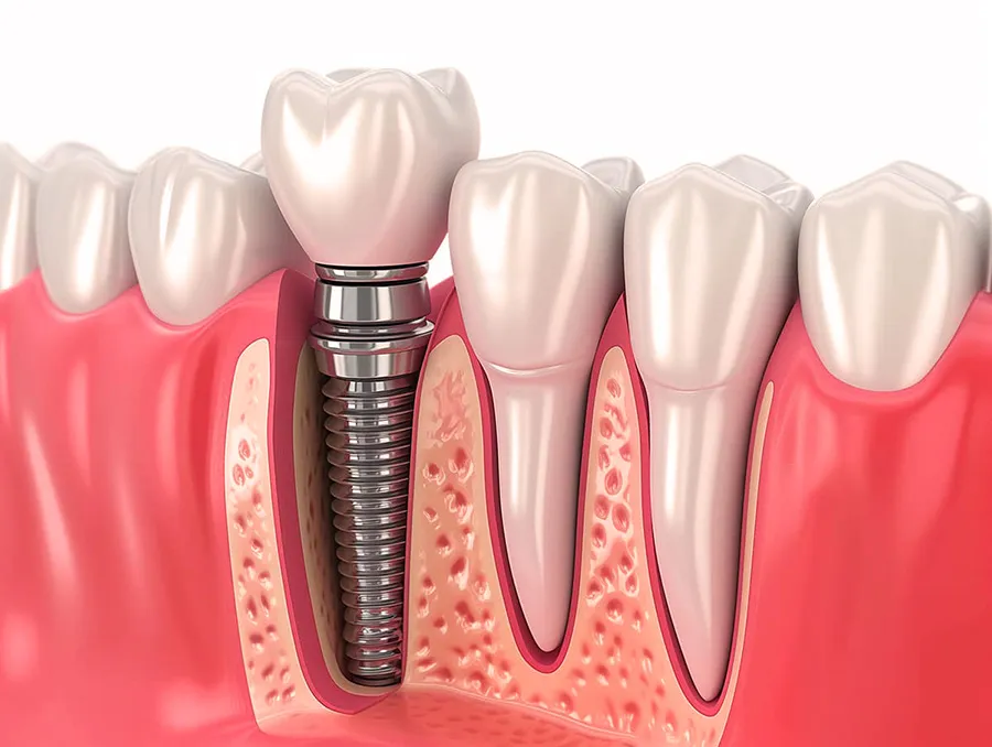 dental implants turkey