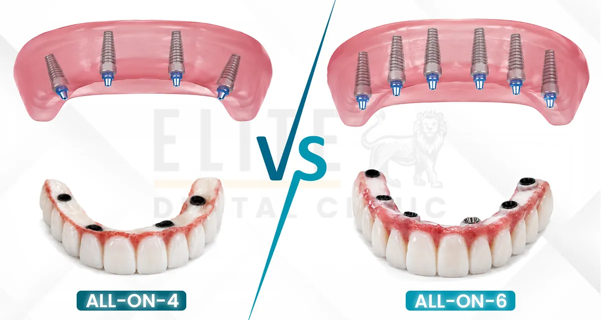 allon4-vs-allon6